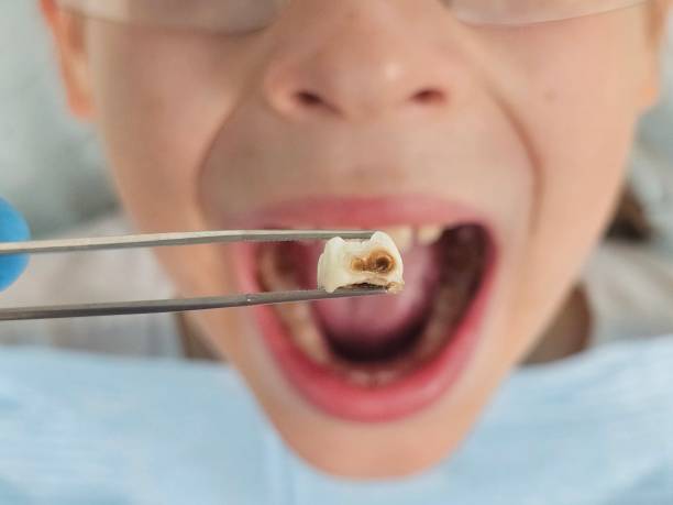 Best Urgent Dental Care for Toothache in Corning, NY